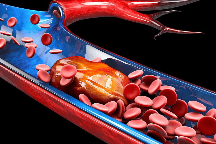 Computer graphic illustrates what a blood clot in the veins looks like and how it obstructs the flow of blood through the body